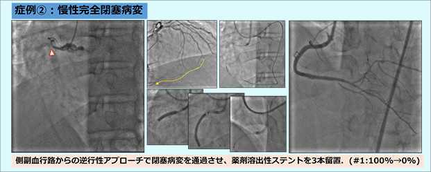 症例②