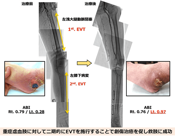 急性・慢性心不全診療ガイドライン2017版より抜粋